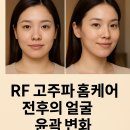 RF 고주파 홈케어, 피부를 되살린 진짜 후기