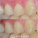 기공마을치과기공소 | 문정역 치과, 치경부 마모증 원인과 레진치료 후기 (교합 문제와의 연관)