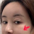 눈이야기 | 2026년도 성형 이야기 second. 눈 밑 지방재배치 후기, 이물질 제거 후기 (심약자 사진 주의)