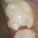 U 치과기공소 | [공지] 신경치료 후 지르코니아 크라운 씌웠을때 비용 구체적으로 정리