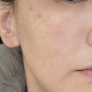 [행복대학] 주름비책 | 신사피부과에서 주름 피고 팔자 핀 여자된 썰. 민트실 리프팅 내돈내산 후기