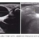 갑상설관낭종(Thyroglossal duct cyst) 이미지