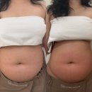 노바 | 압구정에스테틱 "꽁쌤에스테틱" 복부 테라노바 후기