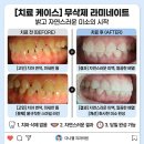 다나수의원 | 천안 '진짜' 무삭제 라미네이트는 다나웰 치과