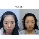 태평양미용실 - 성동구 | 모발이식 리얼후기 (1년 경과)