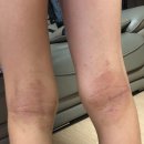 호성프라자약국 | 오금(림프절)과 아토피-호성프라자약국