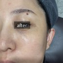 명동시원한의원 | 명동피부과 피코토닝 기미잡티레이저 1차후기