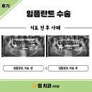 엠치과의원(시지점) | 수성구엠치과시지점) 임플란트 사례 같이 알아보아요 !