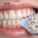 상아 치과의원 | 노원역 치아미백치과, 미백하면 무조건 이가 시린가요?