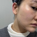 명동크리닝 | 피코하이300토닝레이져 화이트닝 톤업 명동올클리닉 후기