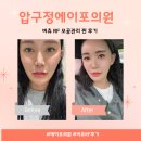 압구정바로미치과의원 | 압구정리프팅 잘하는 곳 ,에이포의원 압구정 버츄 RF 전후비교
