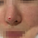 연신내 닥터에버스의원 포텐자 1회 후기, 포텐자 3회 받은 후기