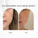 강남우아한바비한의원 | 강남 한의원 리프팅 울쎄라피 프라임 300샷 내돈내산 솔직후기
