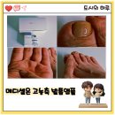 엘메디 | 발톱무좀약 찾다 알게 된 메디셀온 고농축 발톱앰플 1주 사용후기