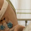 다나의료기 | 폐암 수술 당일부터 퇴원까지의 상세 후기(수술 부위 사진有 주의)