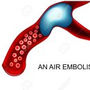 공기색전증[Air embolism]질환이란? 이미지