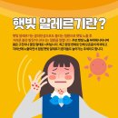 여름철 불청객 햇빛 알레르기 이미지