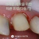 박치과의원 | 증촌마을 치과 앞니 파절 인접면 우식 레진 충치 치료와 트리오스6 구강스캔 활용한 심미보철 크라운