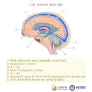 수두증(水頭症: hydrocephalus 이미지