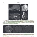 meningocele, meningoencephalocele의 임상학적, 영상학적 특징 및 장기적 예후 이미지