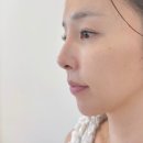 대구 수성구 피부과에서 받은 콜라겐 스킨부스터, 솔직 후기