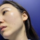 신사역성형외과 결절없는 콜라겐주사 미라콜 후기 얼굴라인 만들기