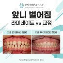 태백섬유 | 청량리 라미네이트 대신 교정으로 앞니 벌어짐 해결한 후기
