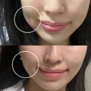 이노메디라인 - 성남시 분당구 황새울로335번길 8 | 신사역 올타이트리프팅 페이스 팔뚝 400샷 600샷 내돈내산 통증 가격 총정리