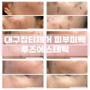 루즈에스테틱 | 대구잡티제거 피부미백 루즈에스테틱 내돈내산 후기(변화과정O)