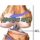 공명 고원 | 1.십자인대파열?