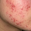 반성제일약국 | 약국 여드름 에크논 크림 사용법 전후 차이 알려드릴게요