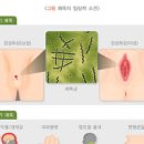 매독 증상 및 원인과 검사 치료 완치 여부 : 여자 남자 이미지