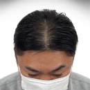 남성(금호) | 약수 금호 강남 40-50대 남성 정수리 두피문신 후기, 실제 변화는?