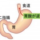 어린이의 역류성식도염은 어느 과를 수진(受診)？ 이미지