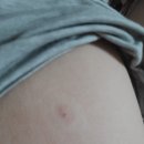 최윤영내과의원 | 아스트라제네카 잔여백신 접종후기