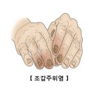 조갑주위염[Paronychia]감염성 질환, 피부질환 이미지