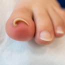 하안사거리 원촌빌딩 앞 | 하안사거리 파고드는발톱, 찌름 심해지면 바로 확인