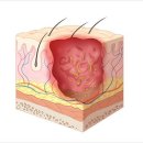 일광보조기 | [물리치료사 임쌤] 피부계 질환 종류 및 물리치료 중재