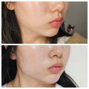 청담동 | 청담동 티타늄 레이저 리얼 후기