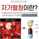 자가혈청주사[Platelet-rich plasma (PRP) injection] 이미지
