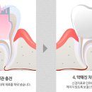 서울바른플란트 네이버블로그
