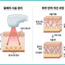 유엔아이퍼스트 | 광교울쎄라, 효과는 어디까지? 볼패임 걱정 전 확인해야 할 점