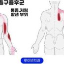 왼쪽 팔 저림 원인 오른쪽 팔이 저림 증상 이미지