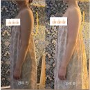 365착한가격 | [광주웨딩관리] 365메디스킨 광주본점/팔뚝웨딩관리/극초단파+수기 후기