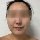 논현2-120 | 강남 논현역피부과 올리디아 스킨부스터 4cc 솔직후기, 콜라겐부스터 솔직후기, 통증