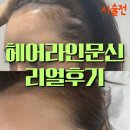 헤어본능 - 시흥시 큰솔로 51 | 부천헤어라인문신 후기 / M자 이마 컴플렉스 탈출한 썰ㅎ