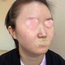 강남JC성형외과 | [휜코낮은코성형] 많이 휘어있던 코 수술을 통해 교정이 되었어요