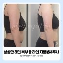 우리집의원 | 상상만 하던 복부 팔 라인 지방분해주사의원 일주일 후기