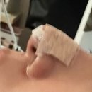 코알바 | 내돈내산 노즈빔 코수술 후기