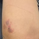 아중푸름신경외과의원 | 미사 화상병원. 파머스 화외과의원 화상 초등아이 화상치료 후기 (화상사진주의!)